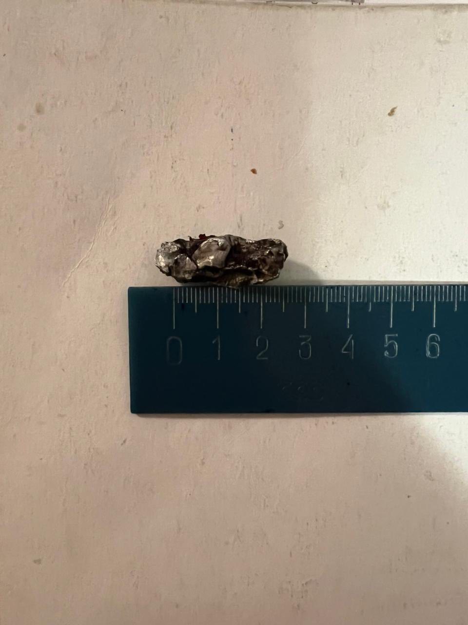 Дніпрянка з великим уламком у нозі рятувала інших після атаки дронів