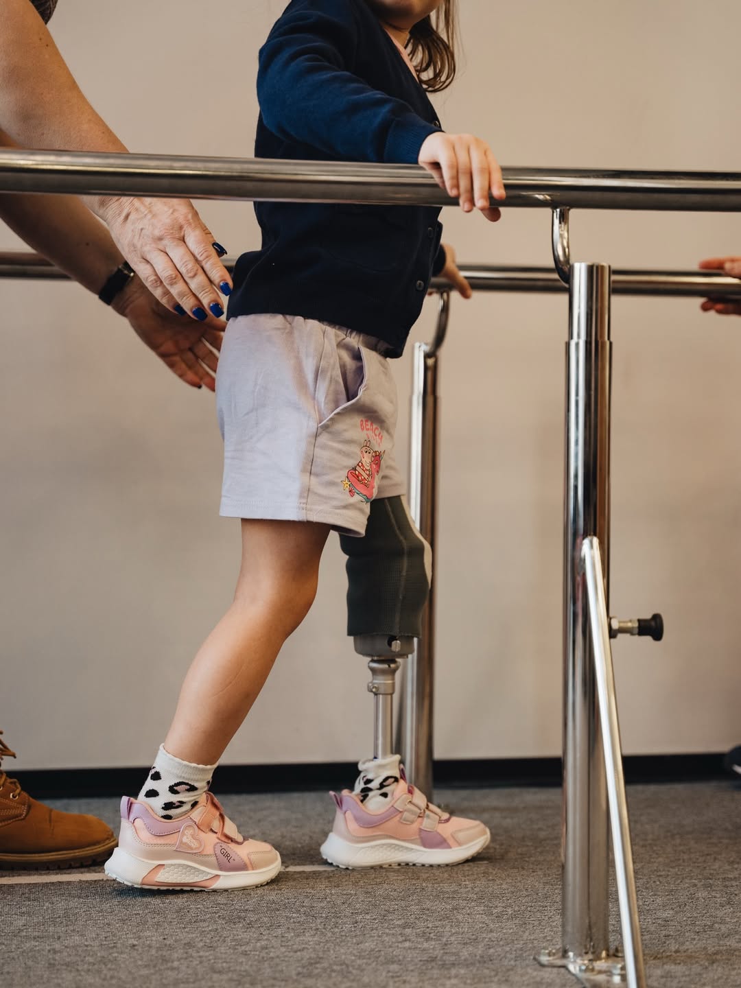 5-річна Марійка з Дніпровщини після поранення зробила перші кроки на протезі